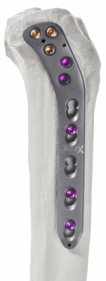 Tibia-proximal-lateral