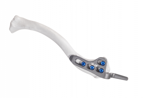 Clavilcle-hook_AF-Medical_164 Clavilcle-hook_AF-Medical_164