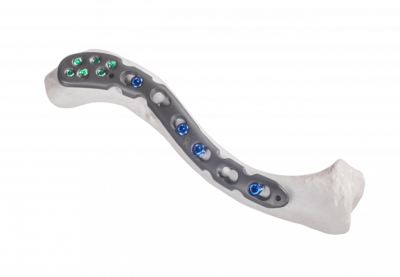 Clavicle-lateral-extension_AF-Medical_165 Clavicle-lateral-extension_AF-Medical_165