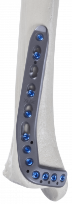 Tibia-distal-anterolateral-1 Tibia-distal-anterolateral-1